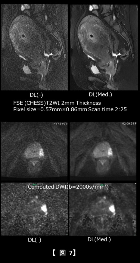 Discovery MR750w MR29.1の臨床活用について | GE HealthCare Discovery MR750w MR29.1の臨床活用について | GE HealthCare